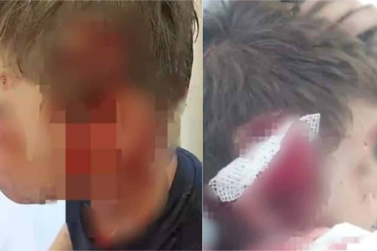 Menino De 6 Anos Fica Gravemente Ferido Ao Ser Atacado Por Cachorro Em São Roque