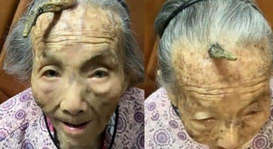 Idosa De 107 Anos Surpreende Internet Ao Mostrar Chifre Que Nasceu Na Testa