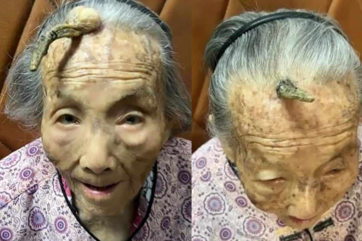 Idosa De 107 Anos Surpreende Internet Ao Mostrar Chifre Que Nasceu Na Testa